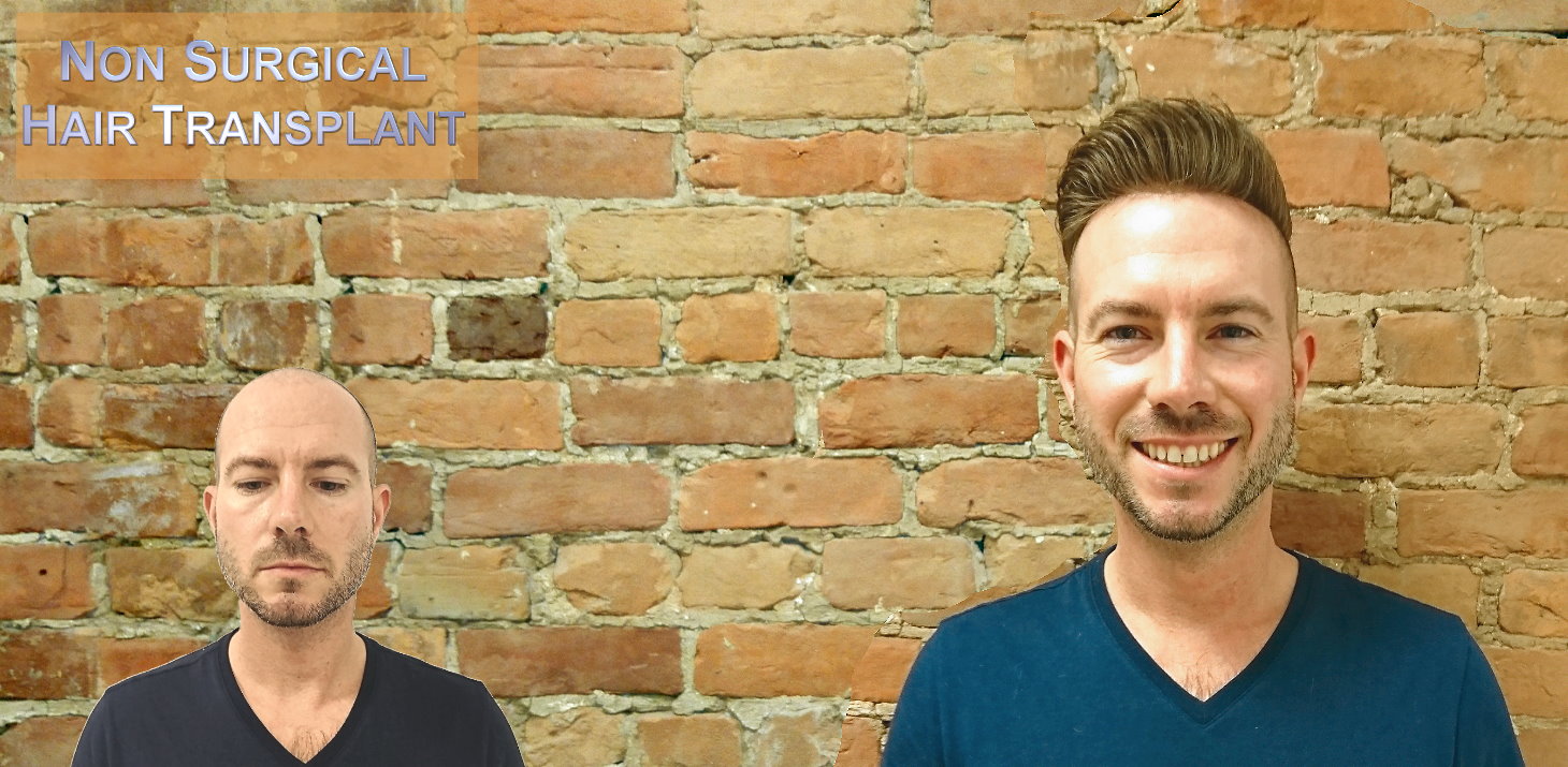 Custom Hairpieces for Men hand crafted at The Hair Clinic Montreal